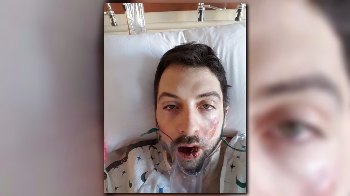 GRAPHIC IMAGES Man hospitalized after vape pen allegedly explodes